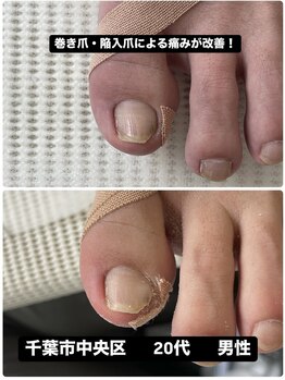 巻き爪じゅん 船橋店/巻き爪・陥入爪による痛みが改善