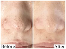 フルール(FLEUR)/ハーブピーリング/ビオフィート