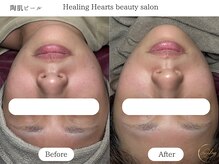 ヒーリングハーツ(Healing Hearts)/陶肌ピールで驚きの変化に！