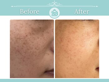 シミケアゼロ美人 表参道店(シミケアZERO美人)/【シミケア/シミゼロ症例】