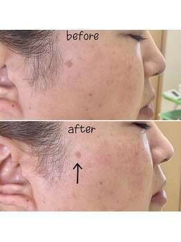 アルディート(Ardito)/ホワイトスノーピール