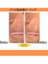 パルティノ 高崎店/ピーリング・剥離なし