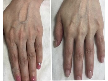 エムフルール(M fleur)/ハンドエステ ビフォアフ