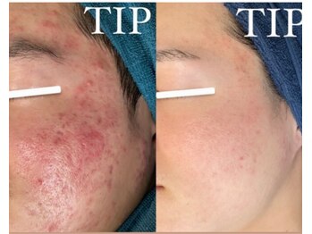 ダリア(Dahlia)/医療提携ハーブピーリング