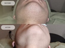 メンズプラス(MEN’S PLUS)/ヒゲ脱毛/ビフォーアフター写真