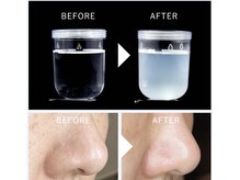 ナチュローズ新小岩/水素水で毛穴を洗浄