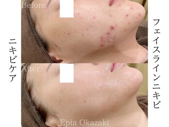 エピア 岡崎店(Epia)/大人ニキビケア・赤み痕ケア