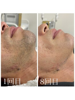 ランプ(LAMP)/~ハイブリッドヒゲ脱毛~