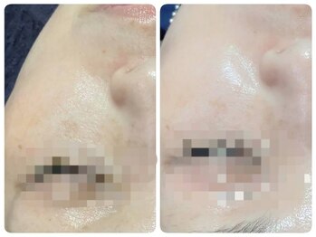 トータルビューティ ノイド(Noid)/毛穴洗浄　全顔フル