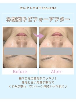 セレクトエステ シュエット(chouette)/お顔剃りbeforeafter