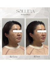 ソルナ 福岡薬院店(SOLUNA)/【小顔調整】