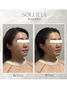 ソルナ 福岡薬院店(SOLUNA)/【小顔調整】