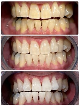 エクシアホワイトニング 日本橋店/日本橋ホワイトニング
