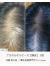 抜け毛や頭皮の透け感が気になる方へ【頭皮】カウンセリング