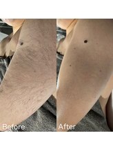 ア レーズ(a laise)/腕のダブル脱毛☆