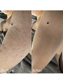 ア レーズ(a laise)/腕のダブル脱毛☆