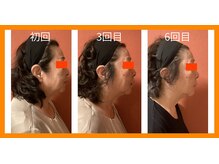 ロイヤリティ(ROYALTY)/70代のビフォーアフター