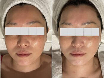 プライベートエステティックサロン クール(Coeur)/【光deエイジングケアコース】