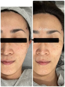 ナナ整骨鍼灸院 ココ(Nana整骨鍼灸院 Coco)/光フェイシャル