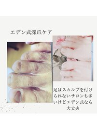 フットの深爪矯正