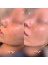 WA ネイル アンド ビューティー(WA nail & beauty)/ホワイトスノーピール2回