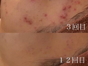 ホワイトアクア 鳳店(WHITE AQUA)/ハーブピーリング 12回目