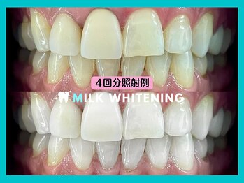 ミルクホワイトニング 新大村店(Milkホワイトニング)/★施術例