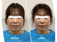 スリー治療院 伏見桃山(THREE治療院)/【むくみ改善】小顔矯正