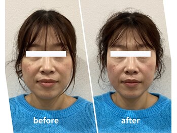 スリー治療院 伏見桃山(THREE治療院)/【むくみ改善】小顔矯正