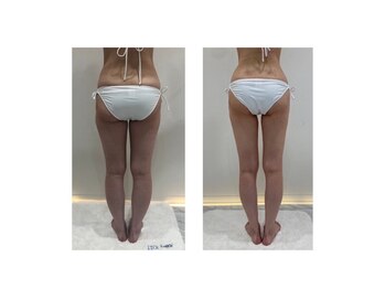 ミーシェ(Meshie)の写真/寝るだけ３０分２万回スクワット級！北陸初導入！我慢なし運動なしで楽してサイズダウンはミーシェだけ♪