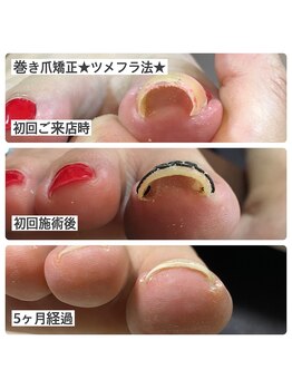 マニュコクーン(ManuCocoon)/爪育成 深爪 巻き爪 大阪市