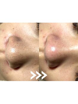 毛穴ケアをしたい