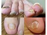 【トラブル爪ケア】爪のお悩みがある方はこちら♪【巻き爪/肥厚爪/副爪】