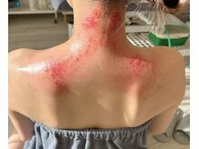 ビレイ(Birei)/カッサ