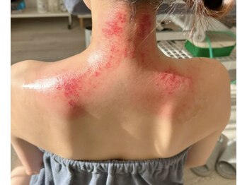 ビレイ(Birei)/カッサ