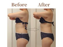 フィオーレ 麻布十番(Fiore)/1回施術のお腹ビフォーアフター