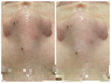 トータルビューティ ノイド(Noid)/毛穴洗浄　全顔フル