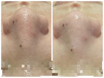 トータルビューティ ノイド(Noid)/毛穴洗浄　全顔フル