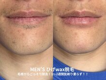 ピブ(pib.)/ツルツル清潔感UP！