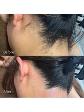 アピール(Appeal)/うなじWAX脱毛