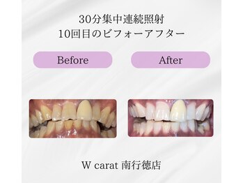 ダブルカラット 南行徳店(W carat)の写真/“白くなる”のは、新しい自分に出会うためのきっかけ♪初めての方でも気軽にまずはお試し体験から！