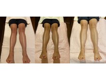 ビサンテ サロン/足甲～膝,透明感&美白美容液導入