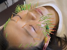 ソラナ(Solana)/美容鍼（百華鍼）