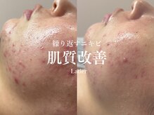 ラティエ(Latier)/ハーブピーリング1回でこの効果!