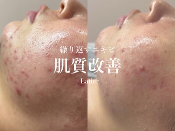 ラティエ(Latier)/ハーブピーリング1回でこの効果!