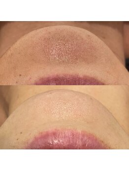 ミューズ(MUSE)/エクストラクション＋美顔フォト