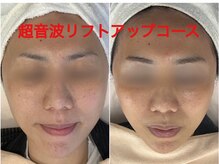 ちゅるん肌.com なかもず店/超音波小顔リフト１回の変化