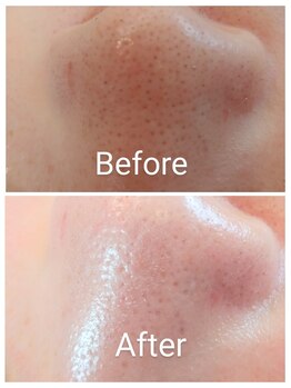 クラリス(Clarice)/お鼻の大掃除してみませんか？