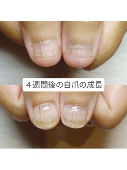 マニエネイル(mani e nail)/深爪矯正4週間後のリアル