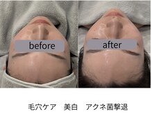 リズ(rE:S)/ブルーピール　20代